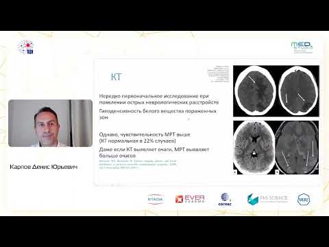 Видео: Задняя реверсивная энцефалопатия: принципы диагностики и лечения. к.м.н. Карпов Д.Ю.