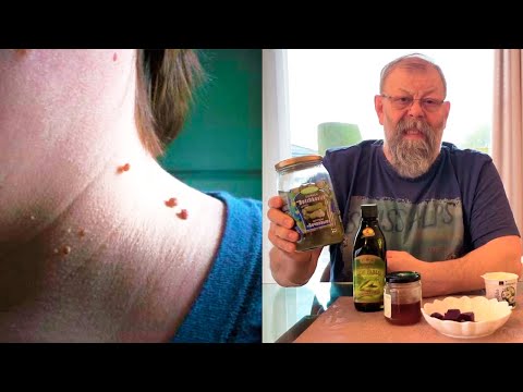 Видео: О чем расскажут папилломы и чего нельзя делать категорически