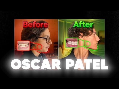 Видео: Вытягивание большого пальца: Доктор Майк Мью выступает