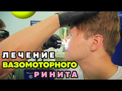 Видео: 🟢 Хирургическое лечение вазомоторного ринита