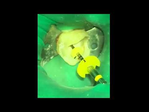 Видео: 2020_09_25 Пульпит за час от начала до конца