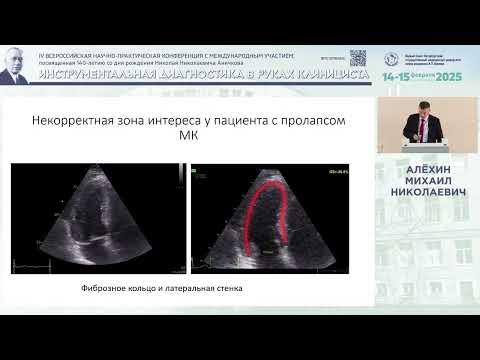 Видео: Методические аспекты выполнения спекл-трекинг ЭхоКГ для оценки продольной деформации ЛЖ сердца