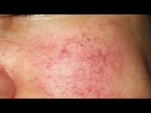 Видео: КУПЕРОЗ. Чем чистить лицо при куперозе дома?