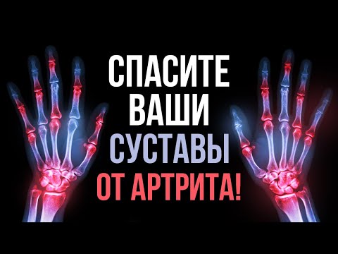 Видео: АРТРИТЫ И ВОСПАЛЕНИЯ СУСТАВОВ! Ревматолог Людмила Шорникова