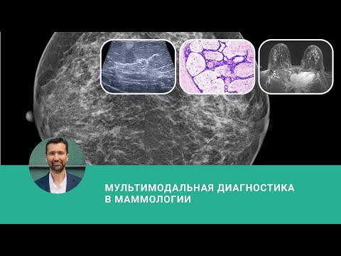 Видео: Мультимодальная диагностика в маммологии - вебинар Mammologicum