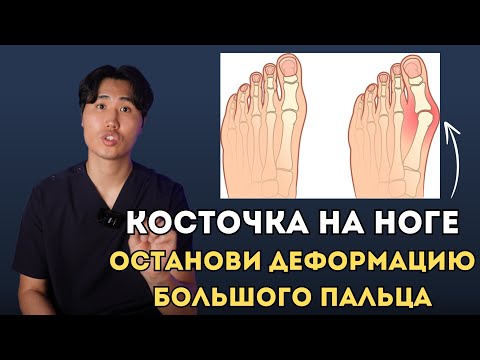Видео: Косточка на большом пальце. Вылечи эти мышцы и останови деформацию большого пальца стопы.