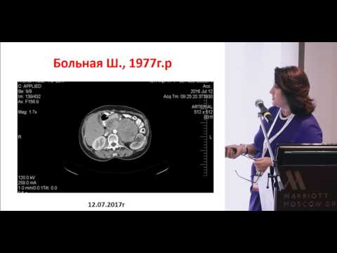 Видео: Высокодифференцированные НЭО ЖКТ: НЭО поджелудочной железы