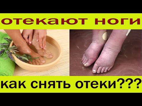 Видео: Как быстро избваться от отеков ног за 1 день..Простые советы