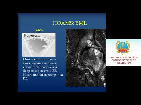 Видео: Блищ О.Ю. «Характеристика и значение шкал артроза тазобедренного сустава по результатам МРТ»