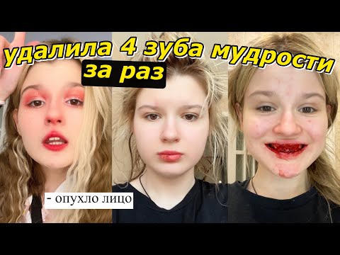 Видео: удалила 4 ЗУБА мудрости ЗА РАЗ..