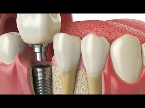 Видео: Имплантация зубов, моя история, честный отзыв.