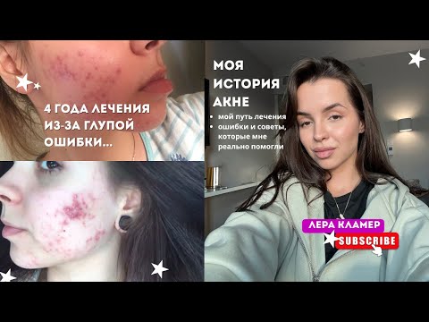 Видео: Как я вылечила АКНЕ? 💊 мои ошибки и советы для идеальной кожи 