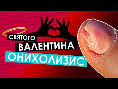 Видео: Онихолизис, протезирование на себе. Маникюр на день Святого Валентина.