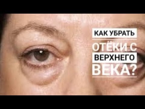 Видео: Как снять отек с верхнего века?