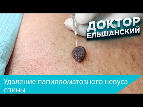 Видео: Удаление папилломатозного невуса спины