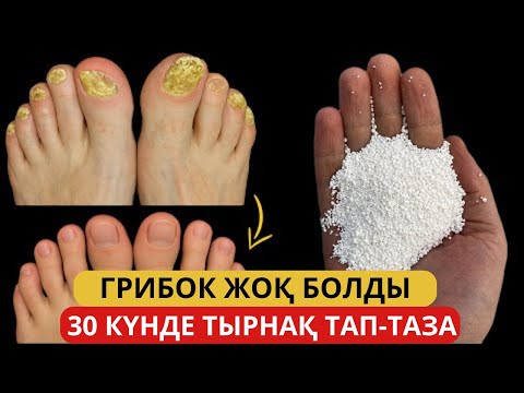 Видео: Небәрі 15 МИНУТ — және ГРИБОК жоғалып кетті! Тырнақ ГРИБОКына арналған зат. Грибокты емдеу жолдары