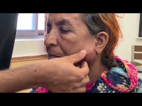 Видео: Осмотр уплотнения в околоушной области #краткий случай #клиническое обследование #уплотнение окол...