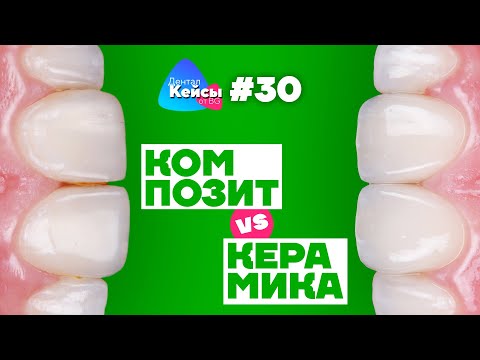 Видео: Композит VS Керамика | Дентал Кейсы от BG #30