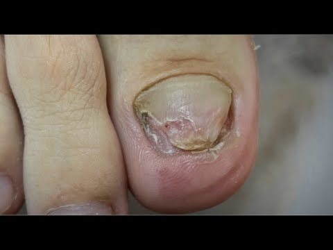 Видео: Онихогрифоз 😳(продолжение)