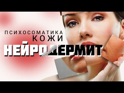 Видео: Нейродермит | #психосоматика кожи | психолог Светлана Радужка