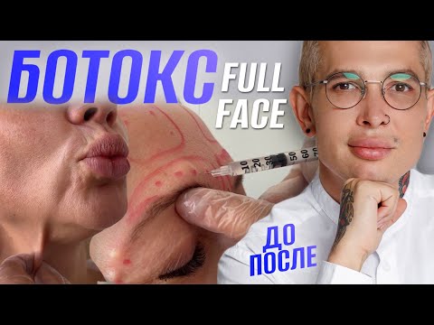 Видео: КАК КОЛОТЬ БОТОКС ПРАВИЛЬНО | FULL FACE ! НЕ колите БОТОКС пока не посмотрите это видео! #ботокс