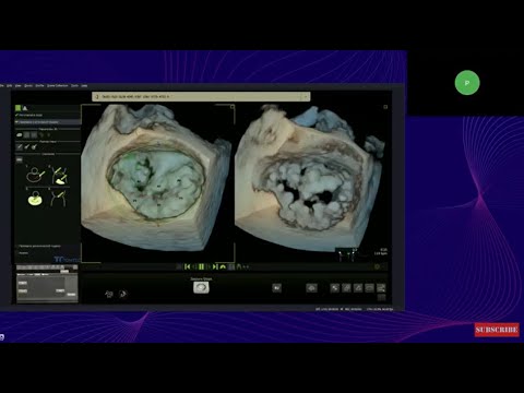 Видео: Инструменты количественной оценки при проведении 3D эхокардиографии на УЗ-аппаратах Philips