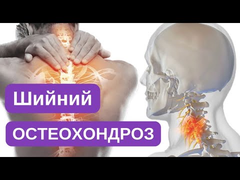 Видео: Остеохондроз шийного відділу хребта