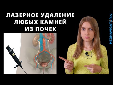 Видео: Лазерное дробление (литотрипсия) камней в почках, мочеточниках, мочевом пузыре | Mednavigator.ru