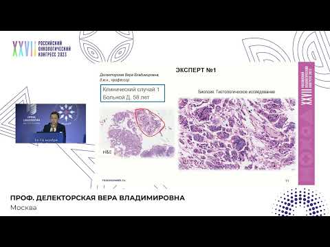 Видео: Эти похожие/не очень опухоли (обсуждение лечения крупноклеточного нейроэндокринного рака желудка)