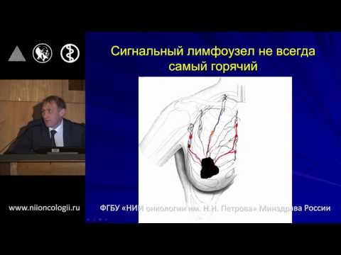 Видео: Методические вопросы биопсии сигнальных лимфоузлов у больных раком молочной железы