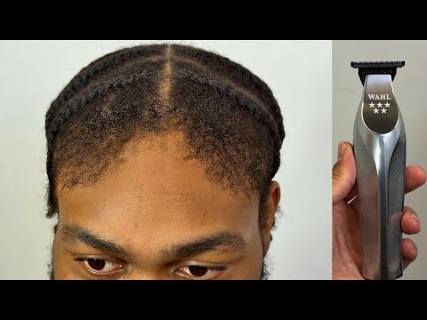 Видео: ЕДИНСТВЕННОЕ решение для ТАКОЙ ПЛОХОЙ линии роста волос