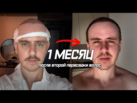 Видео: 1 МЕСЯЦ после ПЕРЕСАДКИ ВОЛОС (второй)