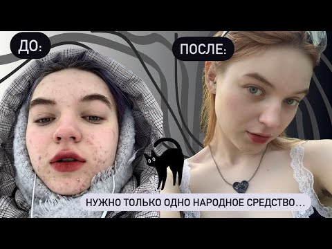 Видео: как я избавилась от прыщей