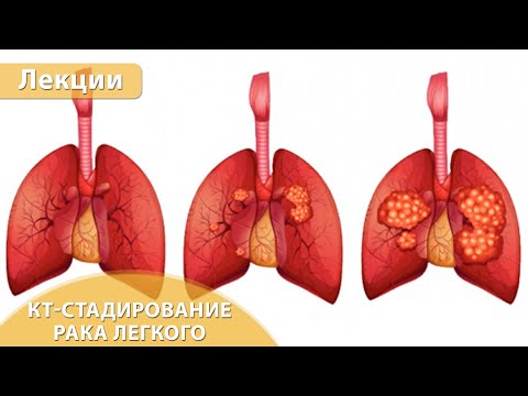 Видео: Часть 3. КТ стадирование рака легкого по критериям TNM8. Андрей Мангов