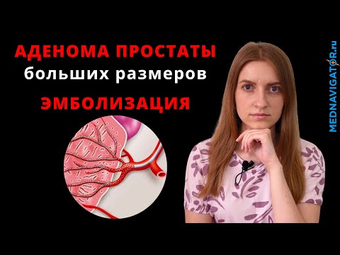 Видео: Лечение АДЕНОМЫ ПРОСТАТЫ больших размеров методом ЭМБОЛИЗАЦИИ артерий простаты | Mednavigator.ru