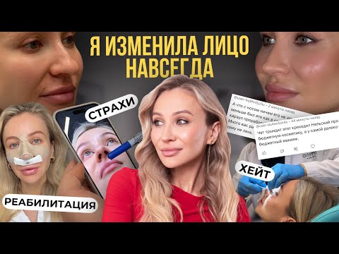 Видео: РИНОПЛАСТИКА: МОЙ ПУТЬ К НОВОЙ ВНЕШНОСТИ | ДНЕВНИК РЕАБИЛИТАЦИИ