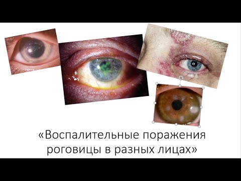 Видео: «Воспалительные поражения роговицы в разных лицах»