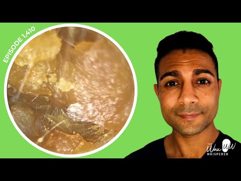 Видео: 1410 — Удаление толстой ороговевшей кожи и ушной серы | **НАПУГАННЫЕ И ВСПОМОГАТЕЛЬНЫЕ АУДИОЛОГИ**