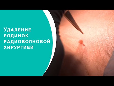 Видео: Удаление родинок радиоволновой хирургией