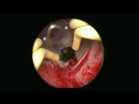 Видео: Мартов А Г - Биполярная трансуретральная электроэнуклеация простаты
