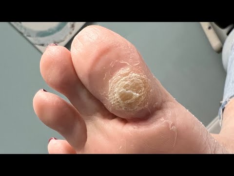 Видео: Удовлетворительное удаление мозолей на больших пальцах ног