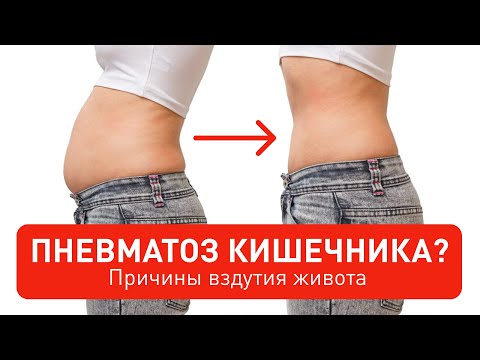 Видео: Пневматоз кишечника, что это? Лечить или нет?
