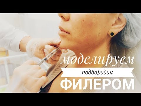 Видео: Моделируем подбородок филером и выполняем инъекции ботокс в лоб и междбровье. Оксана #2
