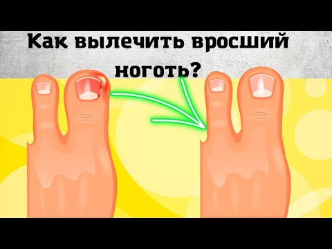 Видео: 6 СПОСОБОВ Как Быстро и Легко Исправить Вросшие Ногти на Ногах