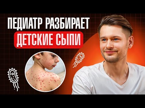 Видео: Сыпь у ребёнка: опасно или нет? Детские сыпи — как отличить и что делать? Объясняет педиатр