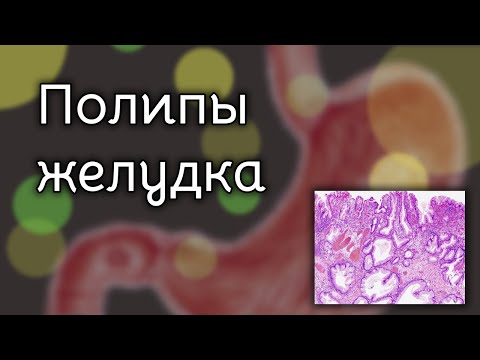 Видео: Полипы желудка | Патология