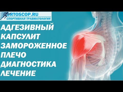 Видео: АДГЕЗИВНЫЙ КАПСУЛИТ.ЗАМОРОЖЕННОЕ ПЛЕЧО.FROZEN SHOULDER