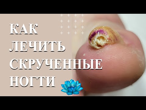 Видео: Вросший ноготь лечение коррекционной системой