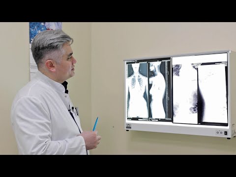 Видео: Хирургическое лечение сколиоза  | Отзывы четырех пациенток