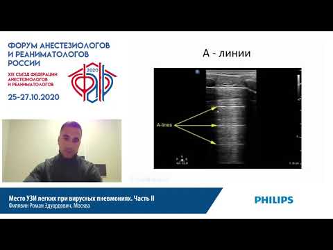 Видео: УЗИ легких при вирусных пневмониях II часть Филявин Р.Э.